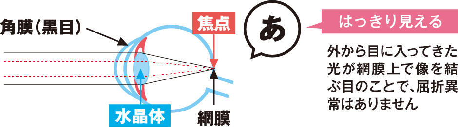 【はっきり見える】外から目に入ってきた光が網膜上で像を結ぶ目のことで、屈折異常はありません