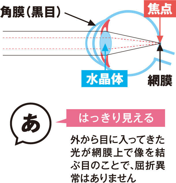 【はっきり見える】外から目に入ってきた光が網膜上で像を結ぶ目のことで、屈折異常はありません
