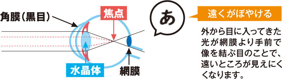 【遠くがぼやける】外から目に入ってきた光が網膜より手前で像を結ぶ目のことで、遠いところが見えにくくなります。