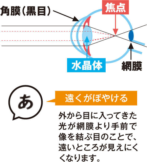 【遠くがぼやける】外から目に入ってきた光が網膜より手前で像を結ぶ目のことで、遠いところが見えにくくなります。