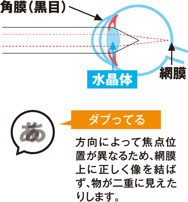 【ダブってる】方向によって焦点位置が異なるため、網膜上に正しく像を結ばず、物が二重に見えたりします。