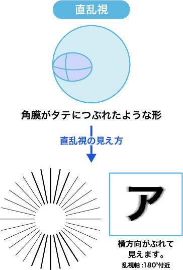 直乱視:角膜がタテにつぶれたような形 直乱視の見え方:横方向がぶれて見えます。 乱視軸:180°付近
