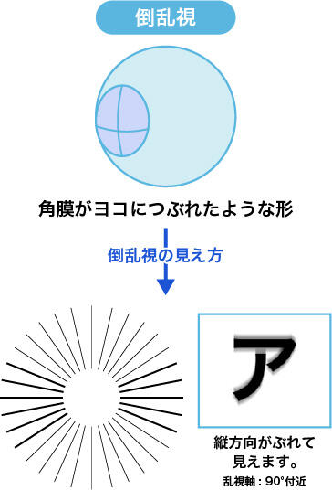 倒乱視:角膜がヨコにつぶれたような形 倒乱視の見え方:縦方向がぶれて見えます。 乱視軸:90°付近