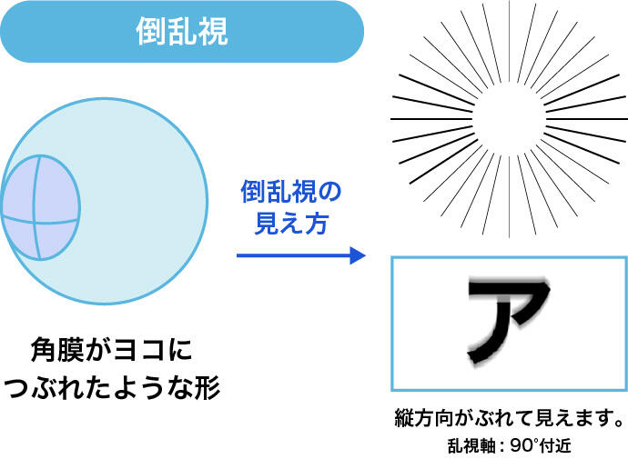倒乱視:角膜がヨコにつぶれたような形 倒乱視の見え方:縦方向がぶれて見えます。 乱視軸:90°付近